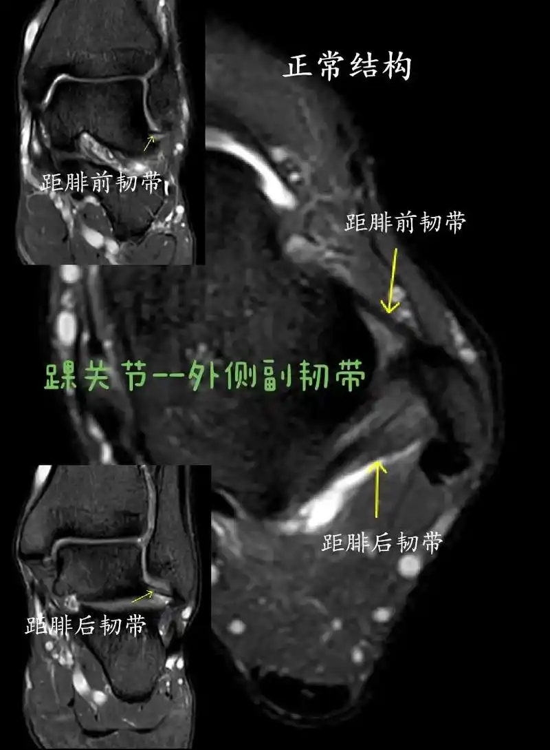踝关节--外侧副韧带.踝关节韧带外侧副韧带由距腓前韧带,跟腓 - 抖音