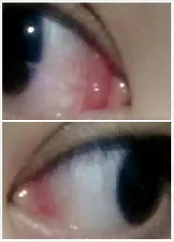 偶尔还会痒,今天揉眼睛的时候发现左眼的内眼角长了一个红肉疙瘩