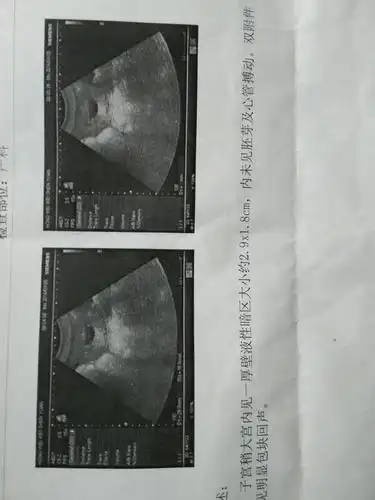 怀孕37天液性暗区大小约2.9x1.8cm正常吗