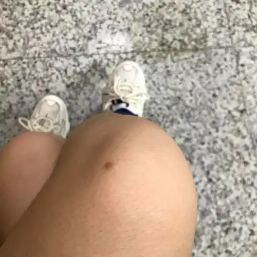 膝盖上长了个包 不痛不痒好几年了
