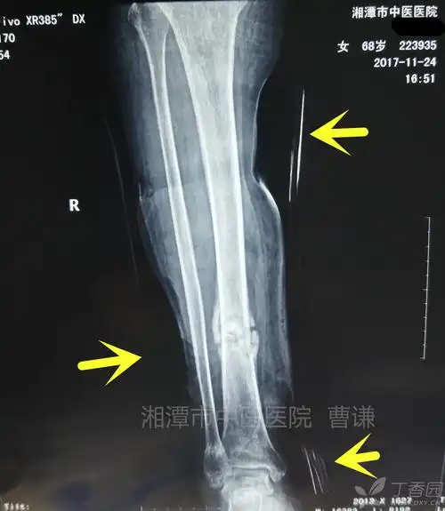 胫骨骨髓炎陈旧骨折如何治疗? [病例帖]