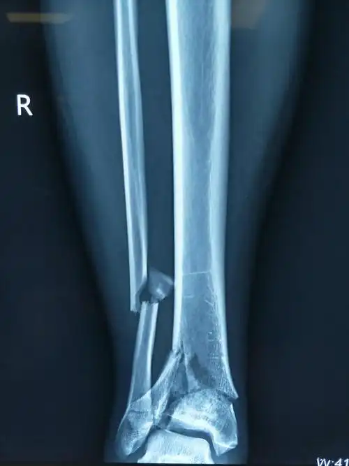 胫骨粉碎性骨折有可能完全恢复正常吗