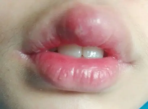 嘴唇肿,就是一小块突出,中间是小小的水泡,很是突兀,有紧绷感,摸起来