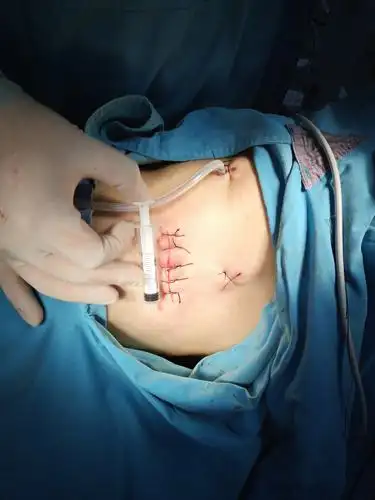 微创手术优点:小切口 下地早 早康复 早出院.