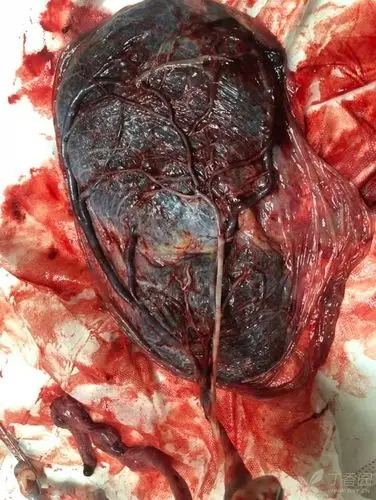 当心!临床你可能会遇见这 5 种形态特殊的胎盘