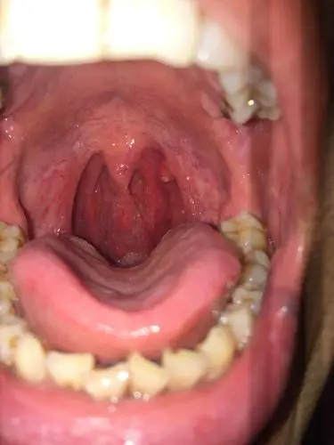 请问大家,喉咙位置经常发炎,有白色的溃疡,是怎么回事?