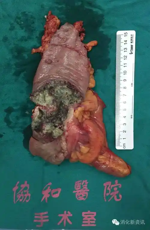 这例结肠肿瘤的深度t3,淋巴结27枚全阴性,环周切缘阴性.