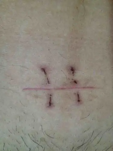 人家结扎后的刀口