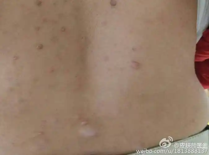 一句话科普:今天我们来认识一种很少见的病《神经纤维瘤病》.