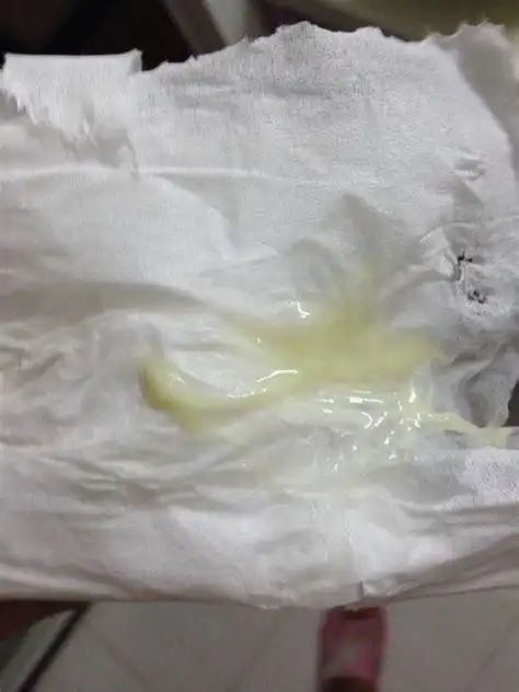 白带异常是怎么回事白带异常吃什么菜好