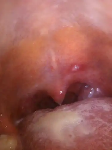 我想问下软鄂上有个小白疙瘩是硬的难道口腔溃疡长这里是凸起来的吗?