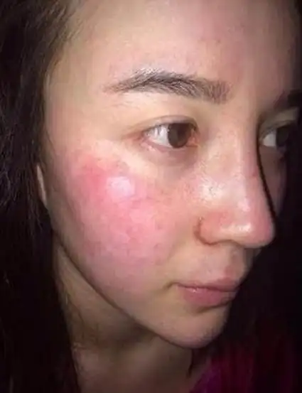 三,激素脸和敏感性肌肤的区别之治疗区别