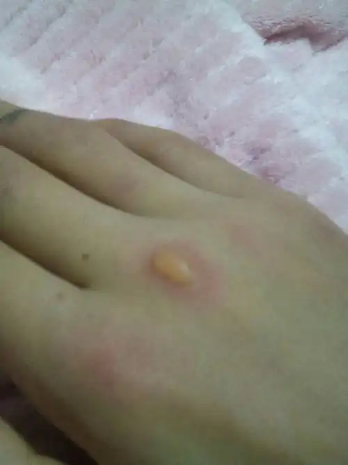 手被热水袋烫成这样的,改怎么办啊!