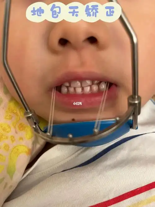 地包天矫正效果