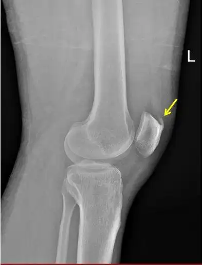 今天学习一下小髌骨,髌骨是人体最大的籽骨,呈扁粟状,上髋为髌骨