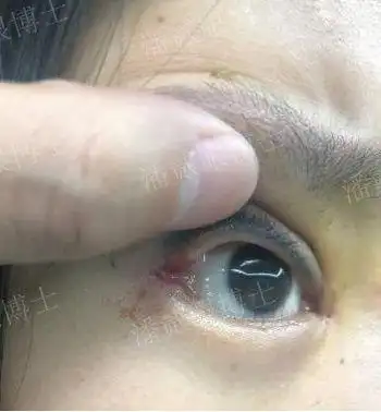 至,开外眼角)虽然火爆,但真心不建议做|下睑|双眼皮|手术|下眼睑_网易