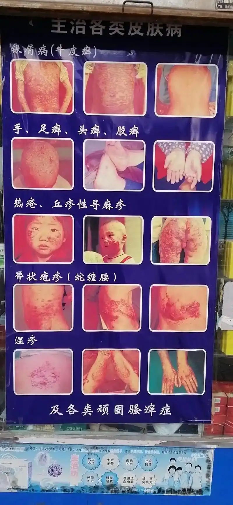 热疮,丘疹性寻麻疹 及各类顽固骚痒症 湿疹 主治各类皮肤病  - 抖音