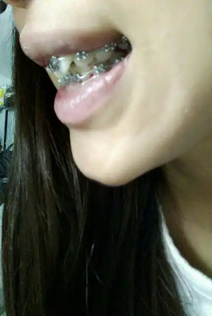 牙的中线不齐,如果对齐了,就像照片里,就会一侧有空隙另一侧已经咬住