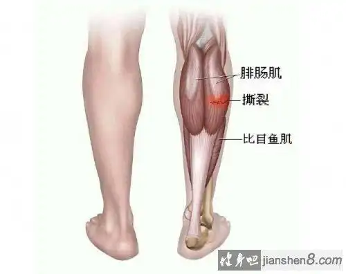 腓肠肌疼痛症状腓肠肌撕裂疼痛怎么办