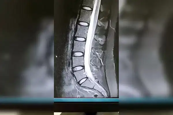 比较正常的腰椎核磁共振扫描矢状面图像显示