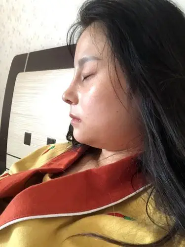 鼻根做太高了可以手术只把鼻根降下来吗,好烦做了14天了,鼻根高得好