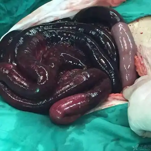 先天性膈疝合并外伤致疝气加重,右侧胸腔全都被肠子疝入,奇怪的是她氧
