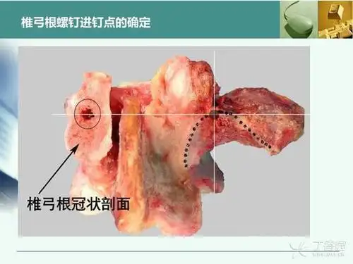 胸腰椎椎弓根置钉技术