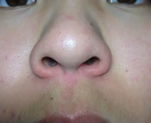 这鼻子上的黑毛孔点点怎么去除啊?专业点!!_百度知道