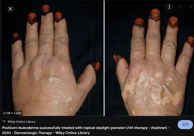 紫外线辐射,可以减缓形成牛皮癣斑块或皮疹的皮肤细胞的过度生长.