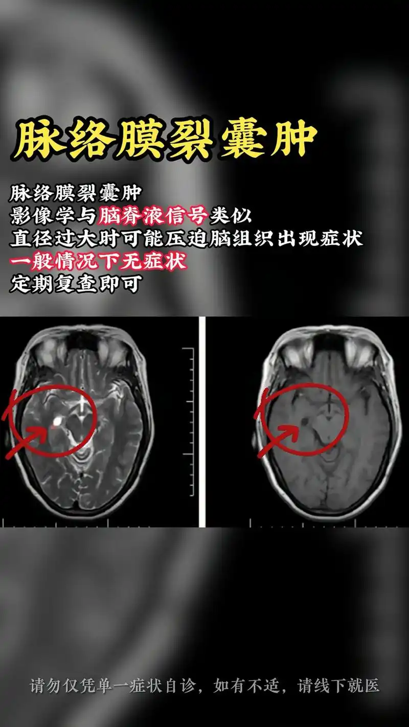 医学影像 脉络膜裂囊肿主要是由先天发育异常引起,一般无明显 - 抖音