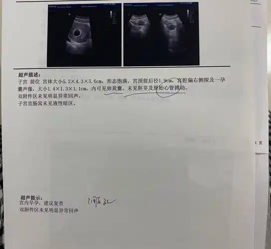 孕五周孕囊圆的像汤圆,是女孩吗?