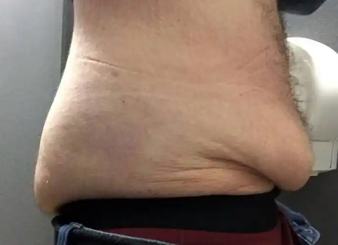 腹壁成形肚子拉皮为什么国外做腹壁成形的人特别多