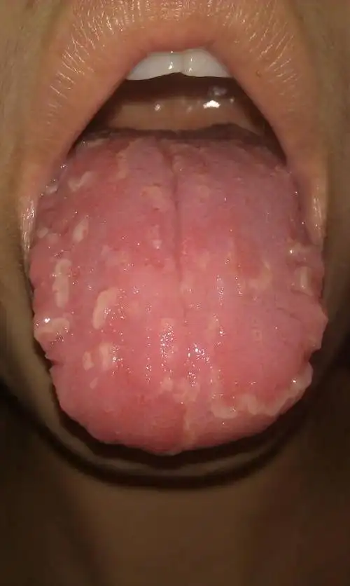 舌头像烂了一样,舌苔很厚 口干怎么办?