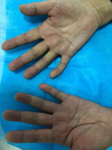 双手大鱼际萎缩
