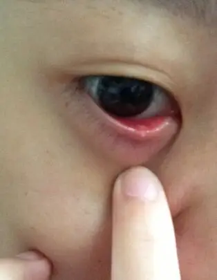 眼睛长针眼了该怎么办呢