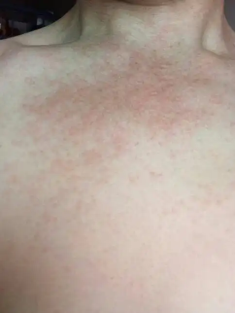 这是痱子还是湿疹,脖子后面也有,很痒的,怎么治