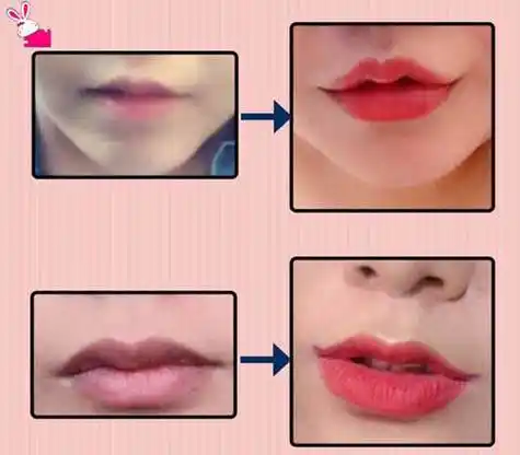 社区 整容头条 > 详细正常的m唇手术不会有什么后遗症的,但是在恢复期