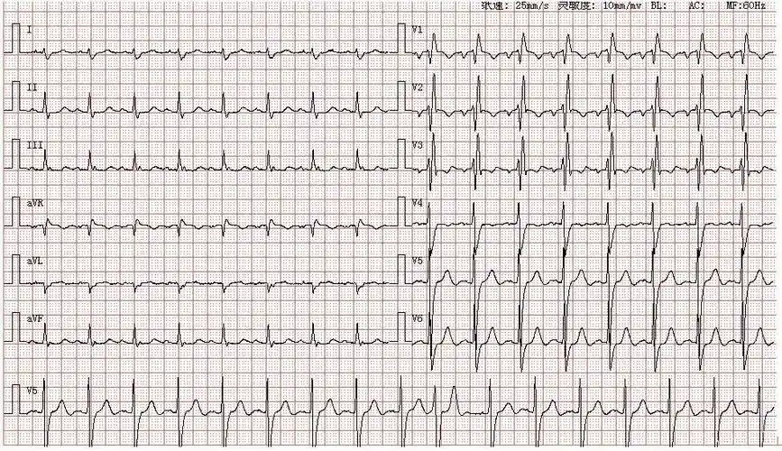 28岁,图为其入院心电图结论:窦性心律一度房室传导阻滞二尖瓣型p波