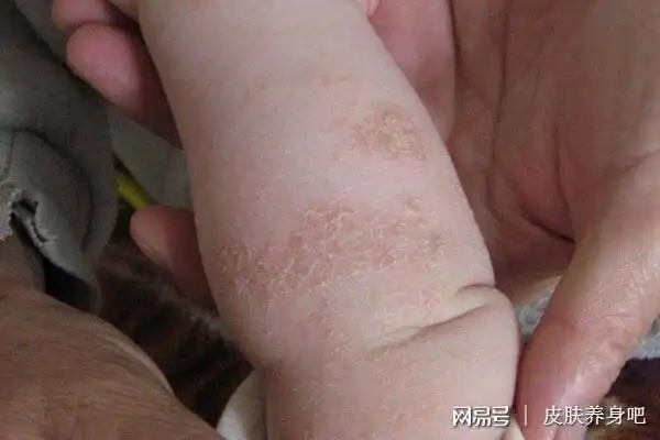 儿童银屑病如何护理?这三点患儿家长你们做到了吗?