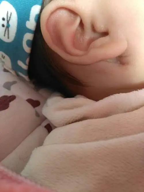 宝宝三个月了,耳朵后有个凹槽.要不要紧,需要就医吗