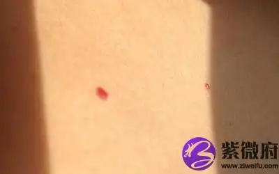胸口有红痣代表什么