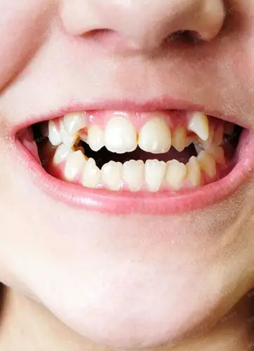 孩子牙齿不齐的3大原因 991.