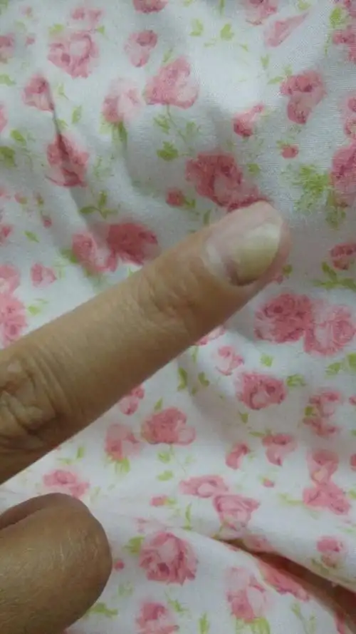 谁知道我这指甲与肉分离了,是怎么回事?