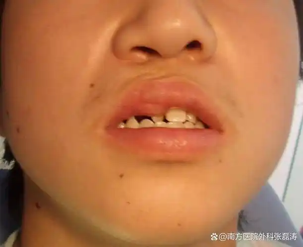 唇腭裂治疗最佳年龄是几岁?不同阶段,需要不同的方式!