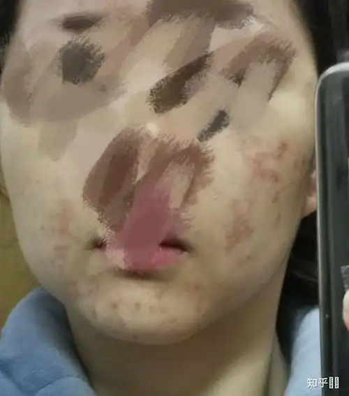 果酸灼伤是什么体验?