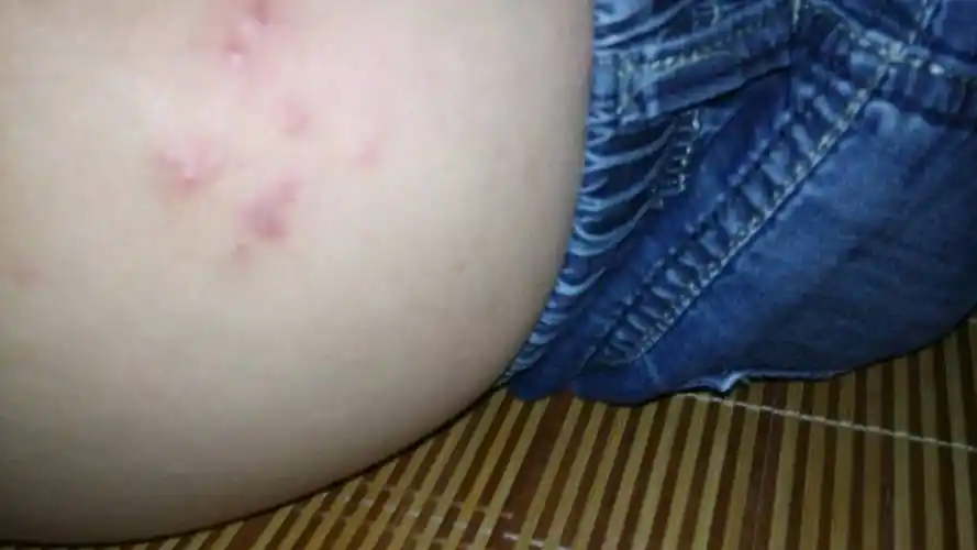 股癣是阴部的一种特殊类型的体癣,是由致病真菌侵入腹股沟内侧而引起