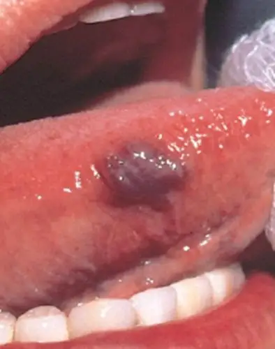 舌头血管瘤临床的表现的图片