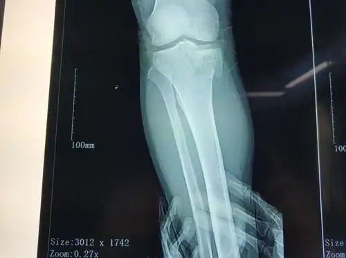 黎平县人民医院骨科完成一例胫骨后内侧平台骨折(mfb‖2c型)粉碎性