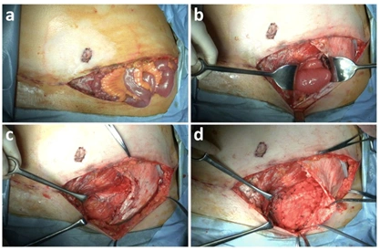 乳腺癌乳房切除术后下腹部皮瓣修复后自发性腹壁破裂