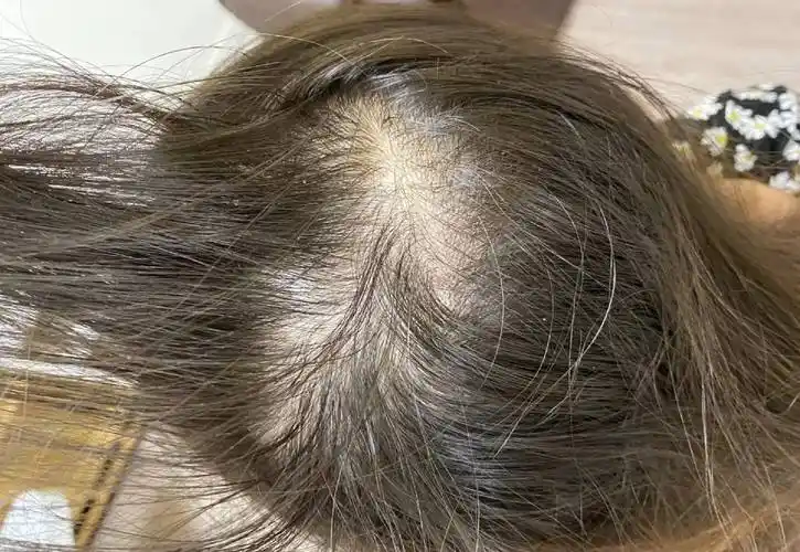 脱发头顶稀疏这么简单就治好了,别说你还不知道!_头发_头皮_按摩